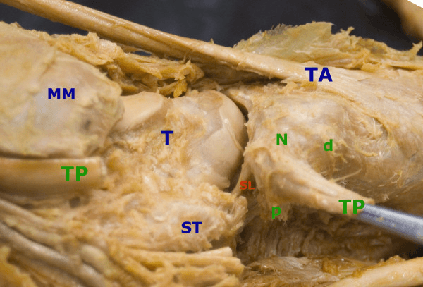 Inferomedial dissection of the opened talonavicular joint, labelled talus (T), navicular (N), tibialis posterior (TP), tibialis anterior (TA), spring ligament (SL) and sustentaculum tali (ST)