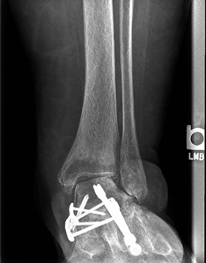 Radiograph showing ankle valgus after medial double arthrodesis