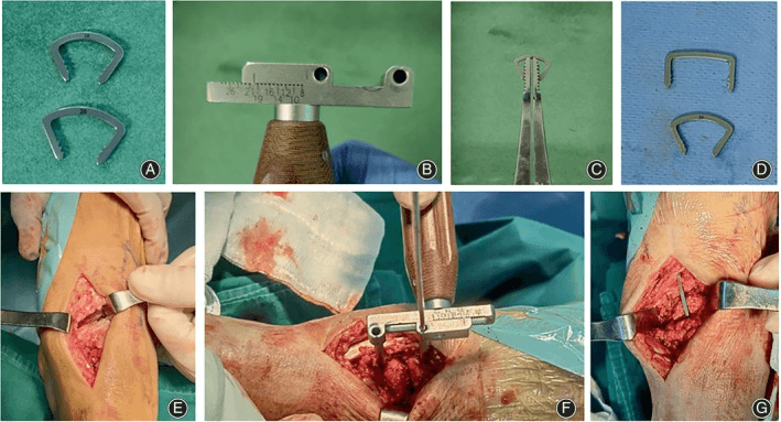 Panels A to G showing shape-memory staples, the drill locator and talonavicular staple fixation