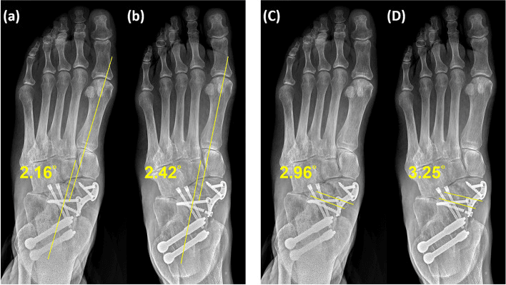 Serial dorsoplantar radiographs after navicular strut-graft arthrodesis, with the AP Meary angle (a, b) and talonavicular coverage angle (C, D) drawn and measured