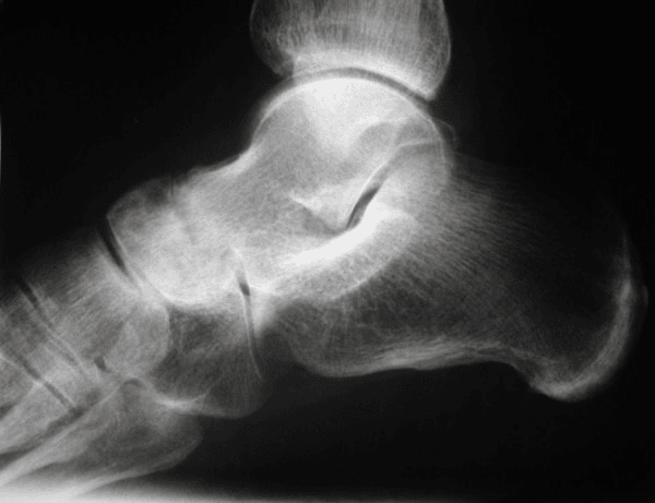 Lateral radiograph of the foot showing destructive talonavicular arthritis