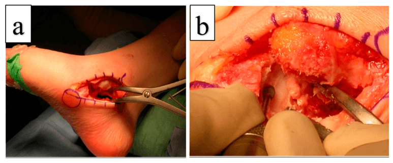 Operative exposure (a) and preparation (b) of talonavicular and subtalar fusion surfaces