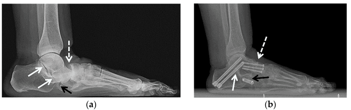Preoperative (a) and postoperative (b) lateral radiographs of post-traumatic talonavicular arthritis and planovalgus treated with triple arthrodesis
