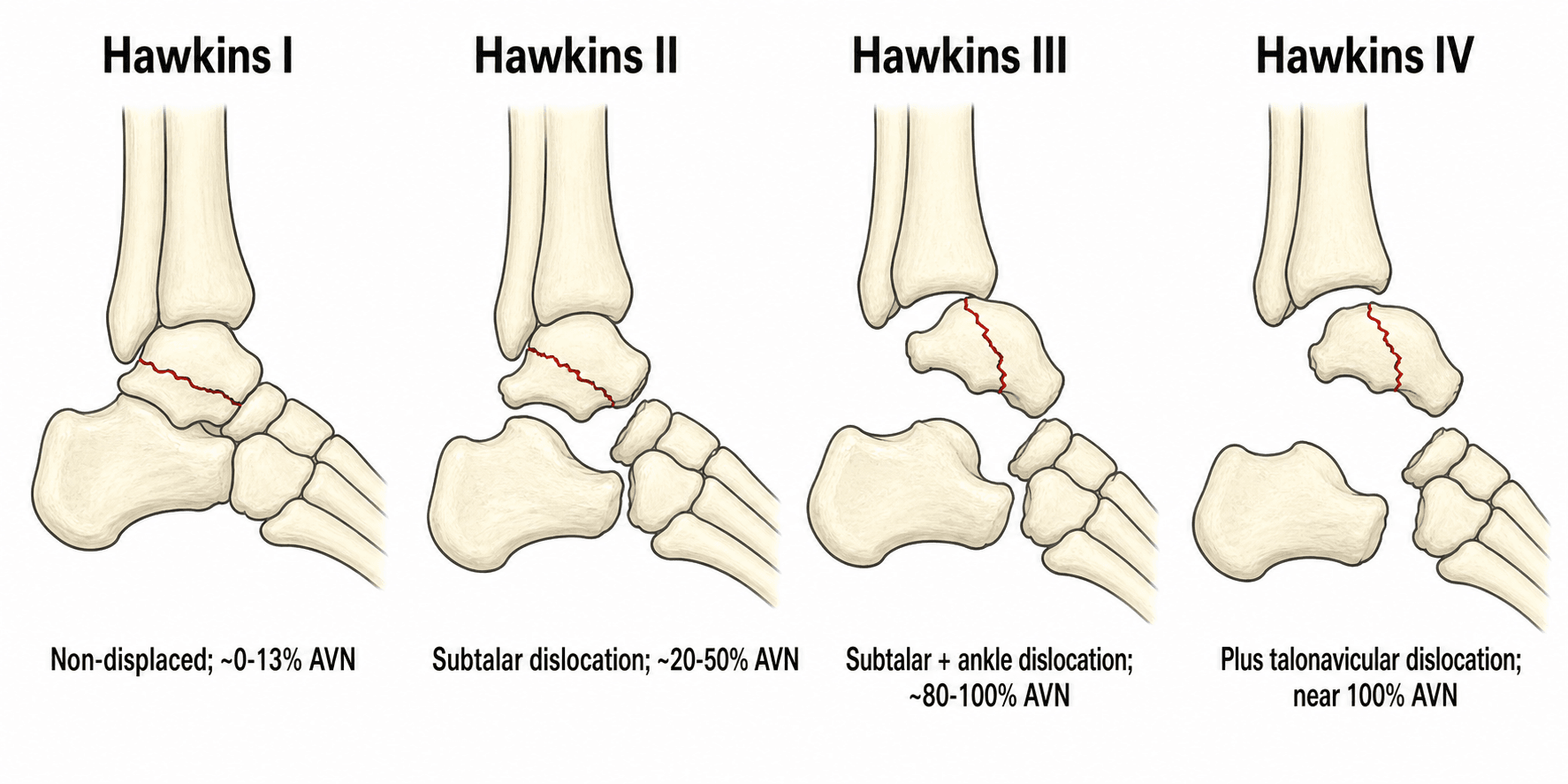 Hawkins classification of talar neck fractures, types I to IV, with avascular necrosis risk.