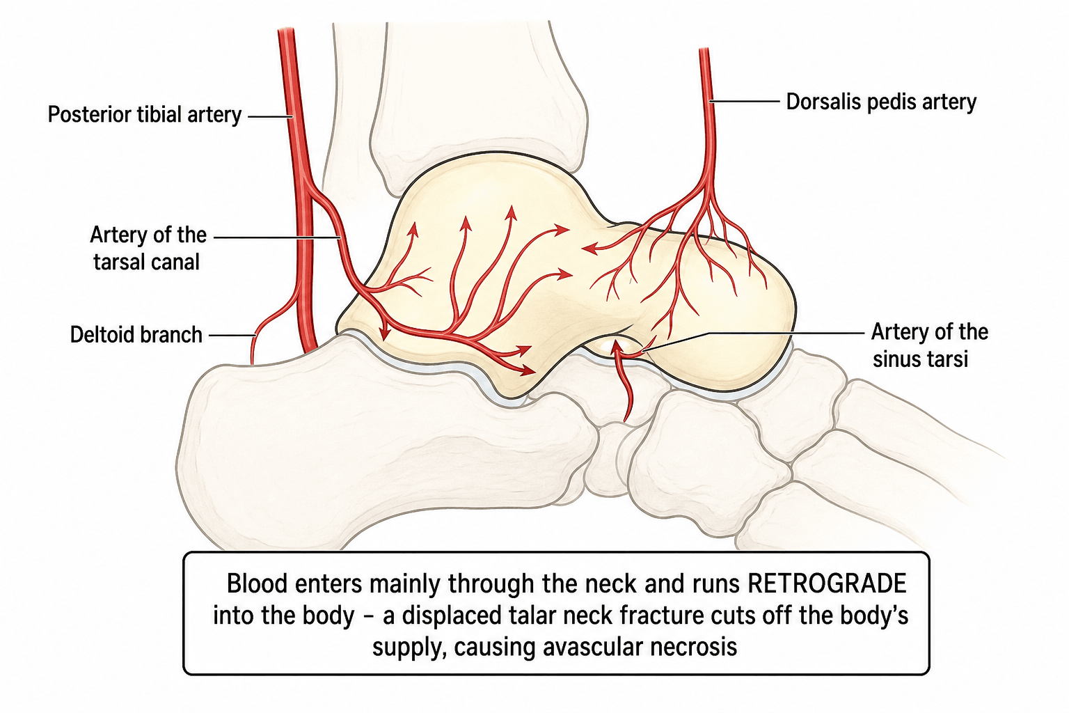 Diagram of the arterial blood supply of the talus explaining its avascular necrosis risk.