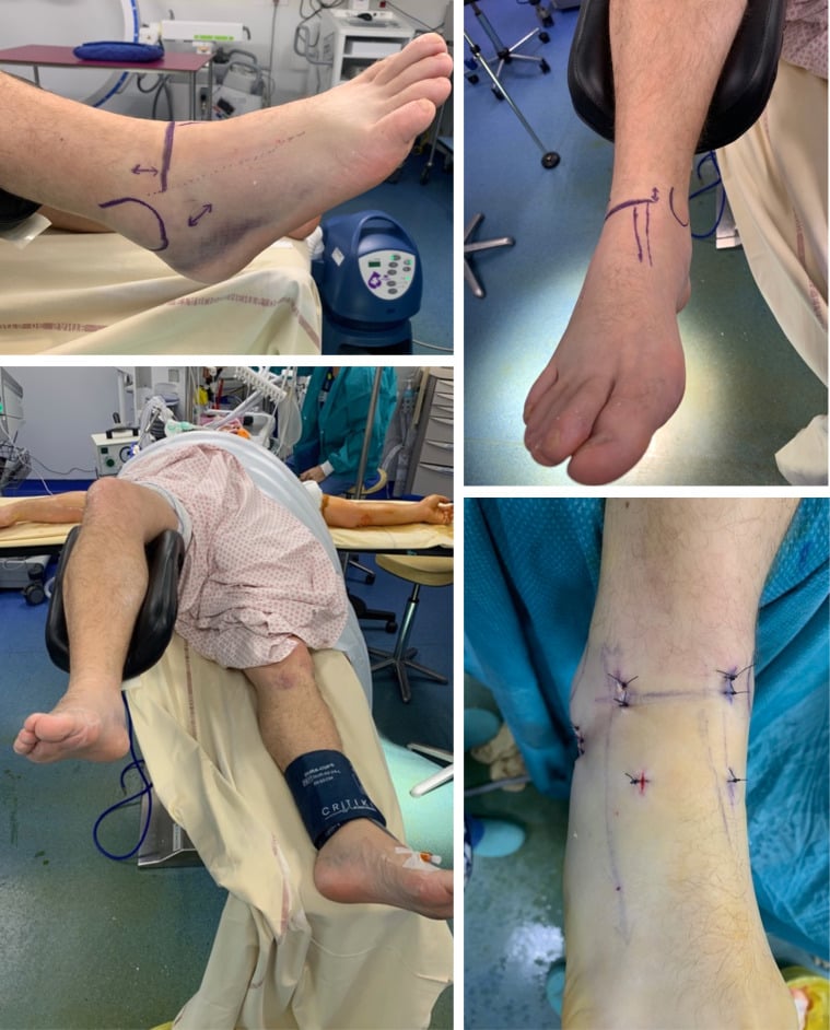 Patient positioning, portal markings and incision plan for arthroscopic-assisted anterior-to-posterior screw fixation of a talar body fracture