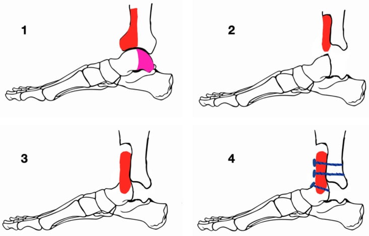 Four-stage schematic of Blair fusion with talar-body excision, anterior tibial sliding graft and screw fixation to the preserved talar head and neck
