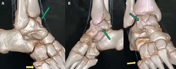Three-dimensional CT views showing a complex talus fracture extending through the head, neck, body and subtalar joint with osteochondral fragments
