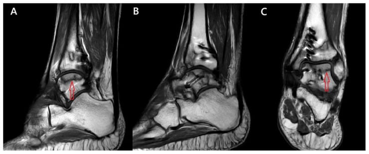 Sagittal and coronal ankle MRI showing early avascular necrosis within the talar body after fracture fixation