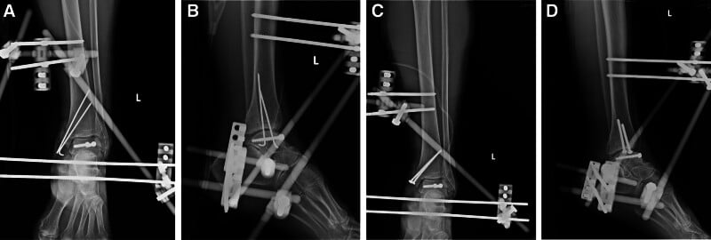 Serial ankle radiographs after reimplantation of a nearly extruded fractured talus with staged external and internal fixation