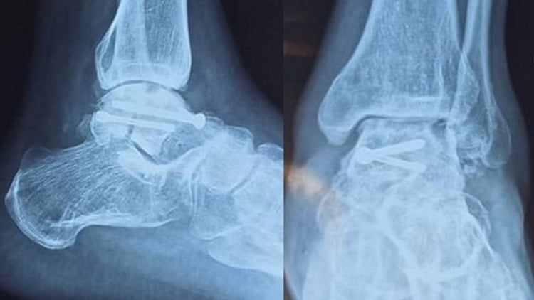 Six-week lateral ankle radiographs showing subchondral talar-dome lucency consistent with a positive Hawkins sign