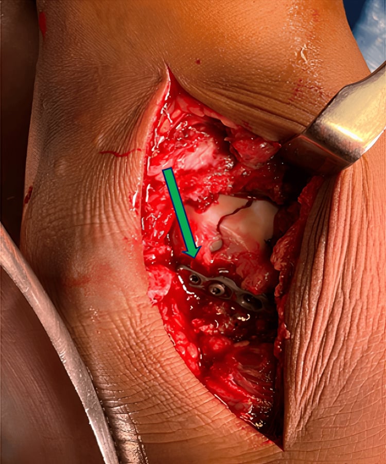 Anterolateral operative exposure showing mini-fragment plate fixation of a comminuted talus fracture