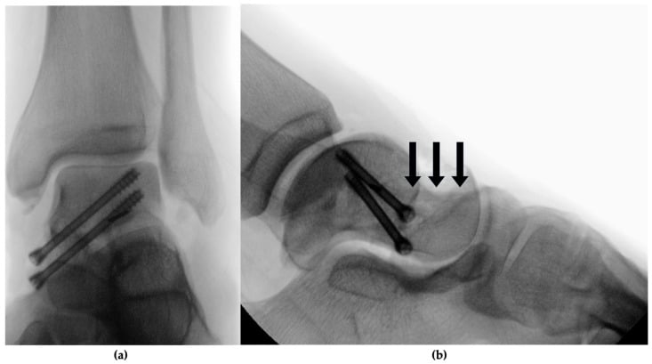 AP and lateral intraoperative fluoroscopy after reduction and screw fixation of a comminuted talar neck fracture