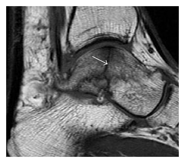 Sagittal T1 MRI of the ankle showing an occult talar fracture.