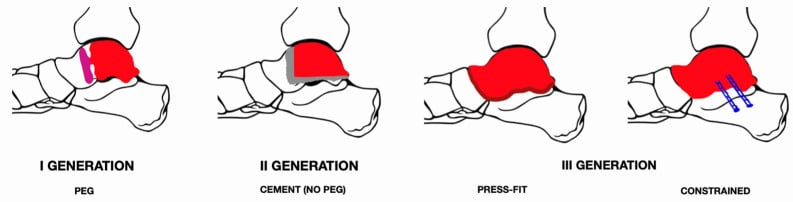 Schematics comparing first-, second- and third-generation total talus prosthesis designs