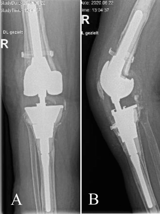 AP and lateral knee radiographs showing loosening around double tantalum cones after repeated septic revision.