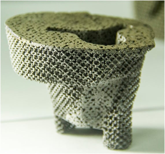 Photograph of a patient-specific 3D-printed pure porous tantalum tibial cone.