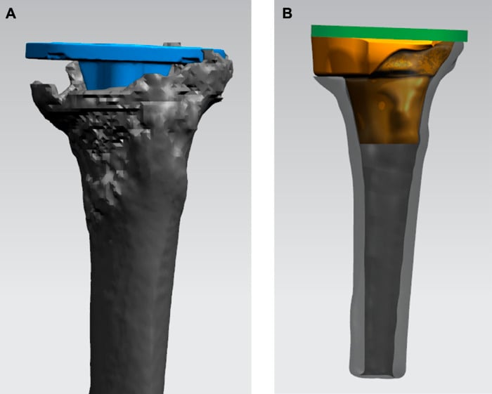 CAD models showing patient-specific design of a porous tantalum tibial cone for revision TKA: A, virtual tibial tray on the proximal tibia; B, the cone beneath the tray.