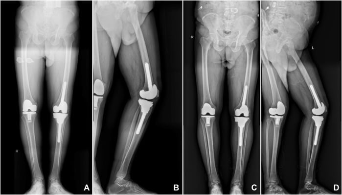 Six-month and three-year knee radiographs showing a stable 3D-printed porous tantalum tibial cone.
