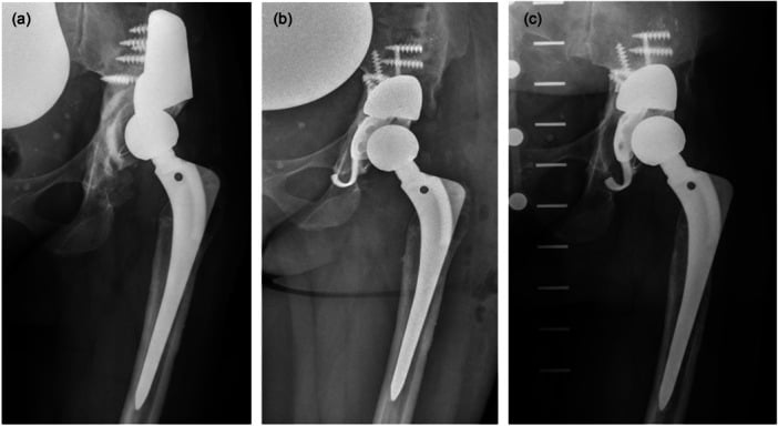 Serial hip radiographs showing medial migration of a tantalum augment and reinforcement-ring construct.