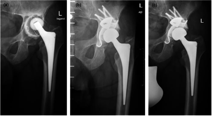 Serial hip radiographs showing severe acetabular bone loss reconstructed with a tantalum buttress augment and ring.