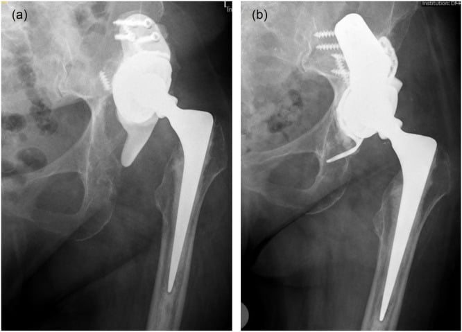 Preoperative and four-year hip radiographs of a tantalum buttress augment with dual-mobility cup.