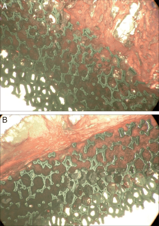 Histological views of bone growing through the porous lattice of a retrieved tantalum cup.