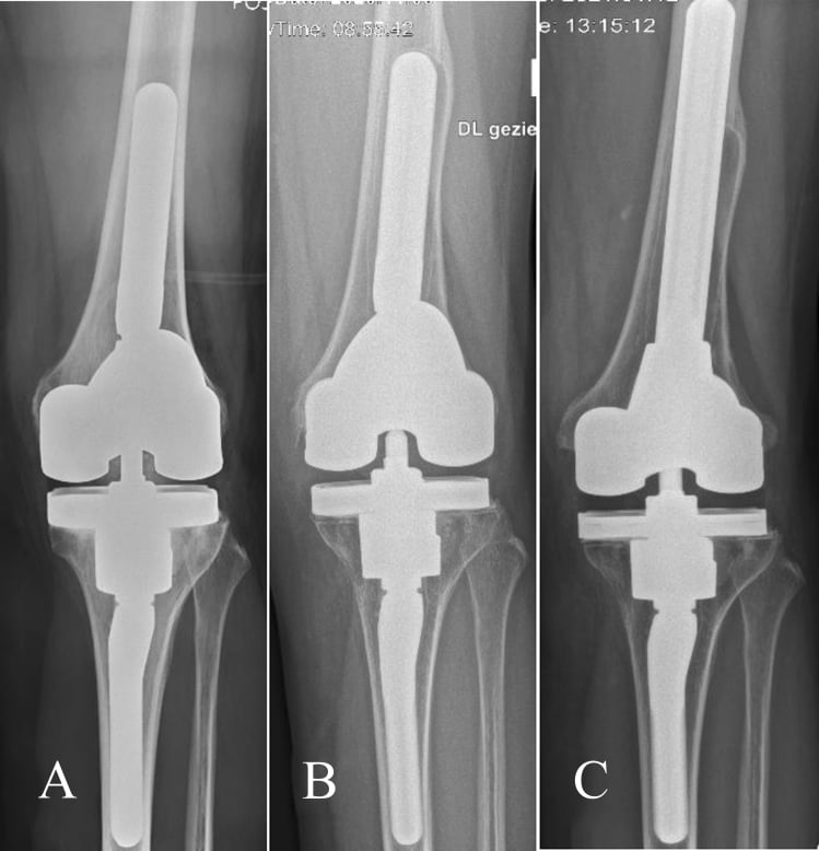 Serial AP knee radiographs showing a stable tibial tantalum cone during isolated femoral revision.