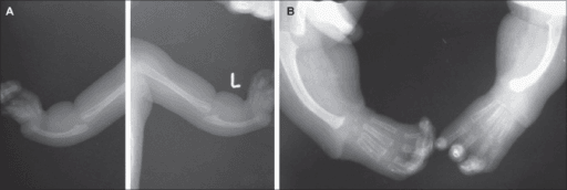 Two-panel radiographic study showing both forearms with a single bone and radially angled hands