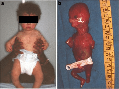 Two clinical panels showing an infant with short upper limbs and a fetal specimen beside a measuring tape