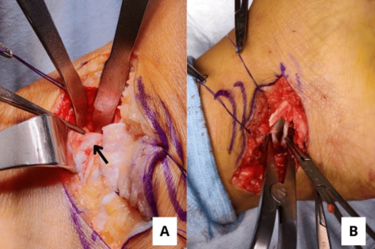 Fibrous talocalcaneal coalition exposed through a posterior approach (A, arrow) and the wound after complete release (B)
