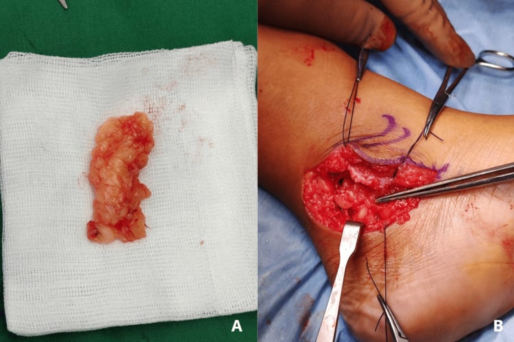 Autologous fat graft after harvest (A) and being secured in a talocalcaneal resection bed (B)