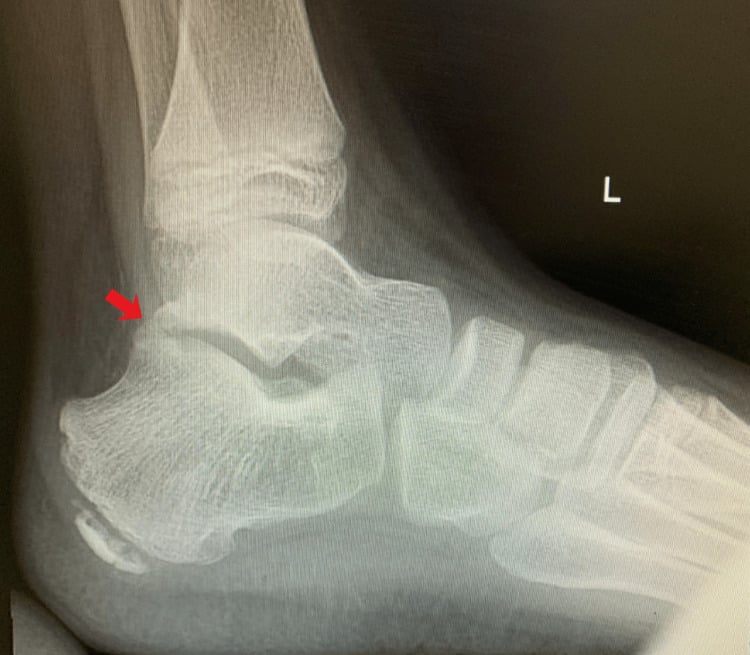 Lateral radiograph marked L showing posterior talocalcaneal bridging, red arrow