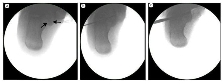 Fluoroscopic localisation of a shingled talocalcaneal coalition (a, arrows) and K-wires passed to define the osteotomy plane (b, c)