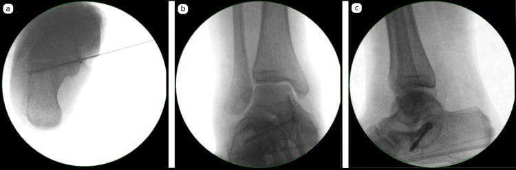 Fluoroscopy of guide-wire placement (a) and cannulated-screw fixation on AP and lateral views (b, c) after deltoid-preserving coalition osteotomy