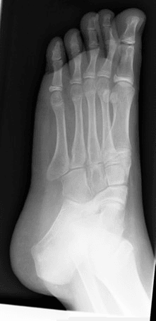 Foot radiograph showing the forefoot, tarsal bones and calcaneonavicular region