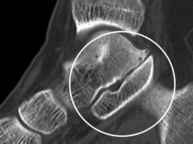 CT of a non-osseous talocalcaneal coalition, with the talocalcaneal interface circled
