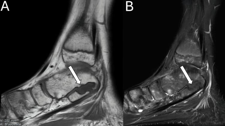 Twelve-month sagittal T1 (A) and fluid-sensitive (B) MRI after talocalcaneal coalition resection with bioresorbable interposition, arrows on the resection bed