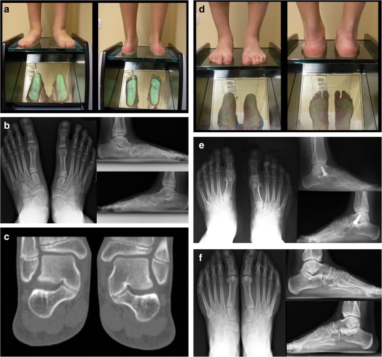 Coalition-associated flatfoot: standing podoscope photographs (a, d), AP and lateral radiographs (b, e, f) and coronal CT (c), with a calcaneal screw visible in e