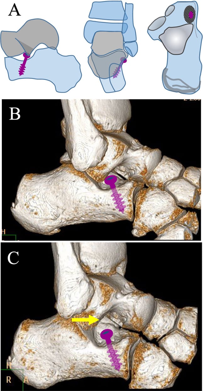 Diagram (A) and three-dimensional CT (B, C) of subtalar extra-articular screw arthroereisis, the screw drawn in purple