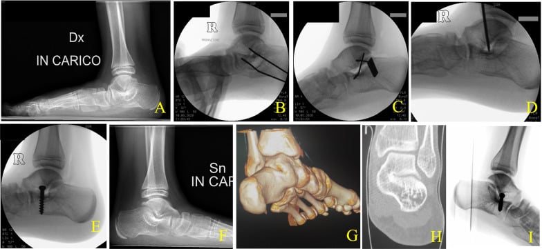 Talocalcaneal coalition resection with extra-articular calcaneal screw: standing lateral radiographs (A, F), intraoperative fluoroscopy (B-E, I), and three-dimensional and coronal CT (G, H)