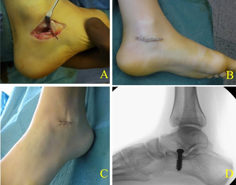Limited incisions for talocalcaneal resection and subtalar realignment (A-C) and lateral fluoroscopy with the calcaneal screw (D)
