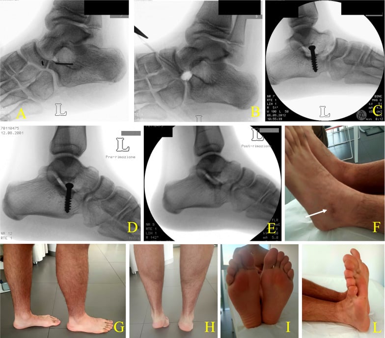 Calcaneonavicular coalition resection with subtalar realignment: fluoroscopy (A-E), including before and after screw removal, and clinical photographs (F-I, L)