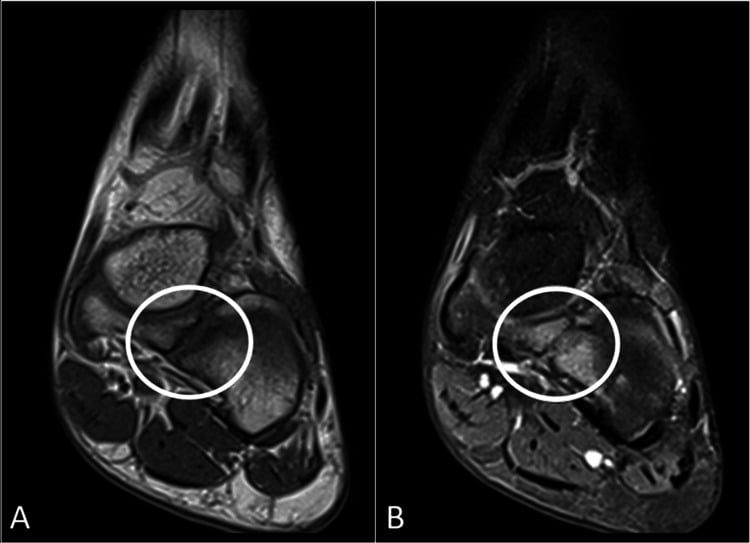 Two MRI panels, A and B, of a fibrous cubonavicular coalition, the interface circled