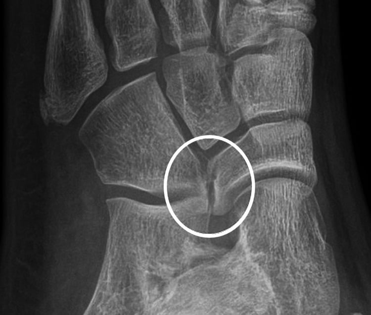 Oblique radiograph of a cubonavicular coalition, the bridge circled