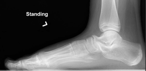 Standing lateral radiograph of the foot