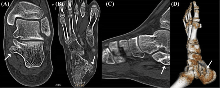 CT in three planes and a three-dimensional reconstruction, labelled A to D, with arrows on a bony protuberance below the sustentaculum tali