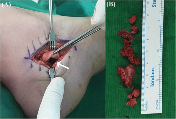 Intraoperative photograph of the space left beneath a retracted tendon after excision of a sustentaculum tali osteochondroma, and the excised bony fragments beside a scale rule