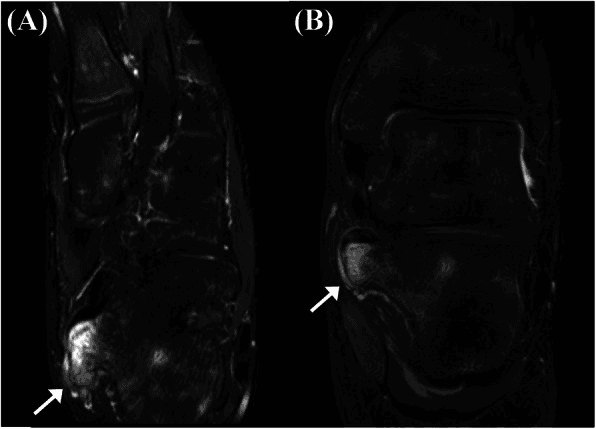Two MRI images, labelled A and B, with arrows on a high-signal, cartilage-capped mass arising from the sustentaculum tali