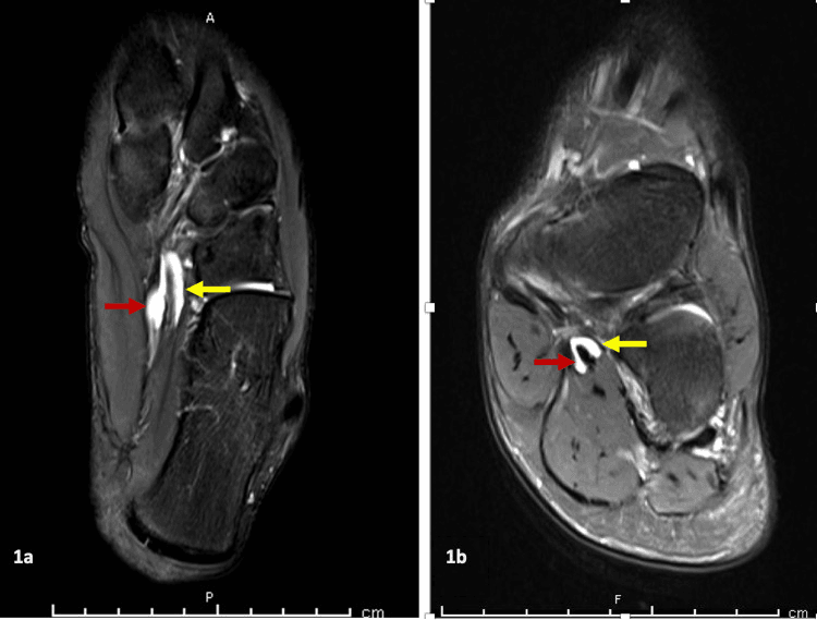 Two MRI images, labelled 1a and 1b, showing fluid around the flexor hallucis longus and flexor digitorum longus tendon sheaths